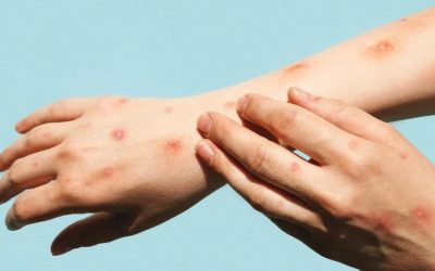 Ibagué reporta dos casos nuevos de Viruela Símica