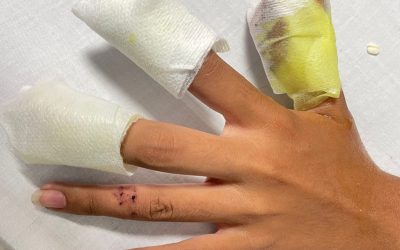 Adolescente lesionada por uso de pólvora, será intervenida quirurgicamente