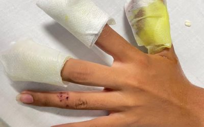 8 quemados con pólvora van en Ibagué