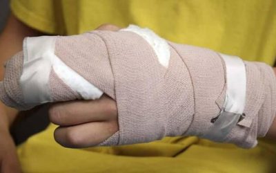 Dos casos más de quemados con pólvora en Ibagué