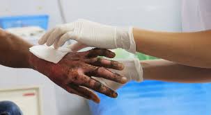 13 los quemados por pólvora, varios de ellos menores de edad