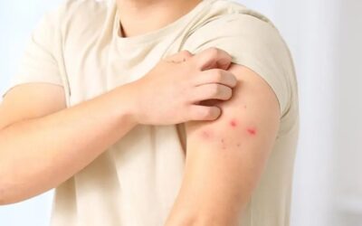 Colombia detecta primer caso de mpox clado Ib en Antioquia